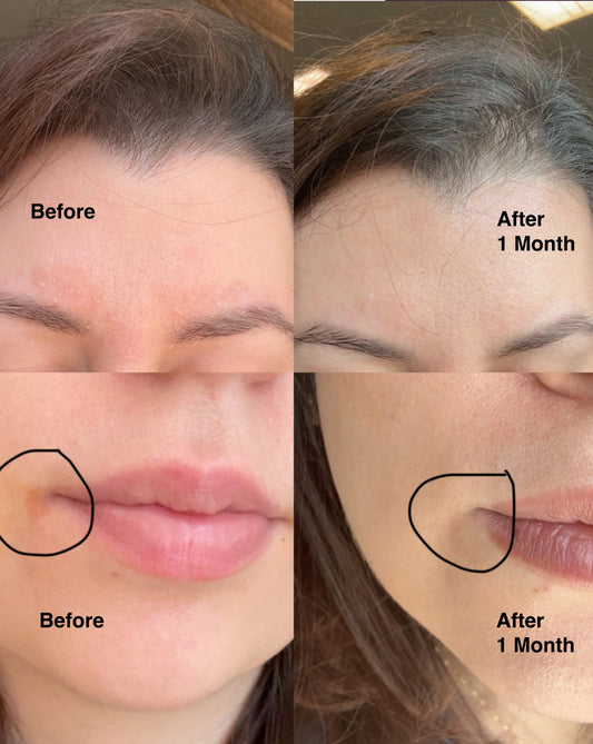 Kat's Story: Healing Her Dermatitis Naturally